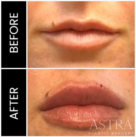 Lip Filler Results Atlanta